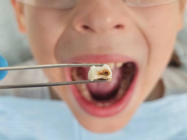 Best Broken or Cracked Tooth Emergency Dentist in West Pensacola, FL