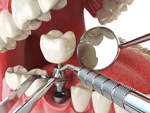 Best Emergency Dental Extractions in West Pensacola, FL